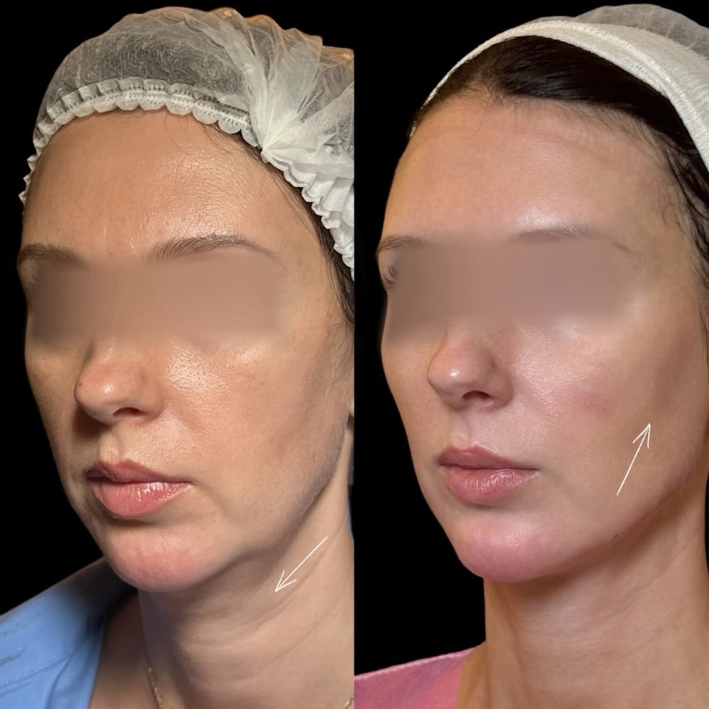 Комплексное омоложение: FaceTite, Aptos и филлеры